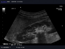 Ultrazvok ledvic - kamen v pielonu ledvice